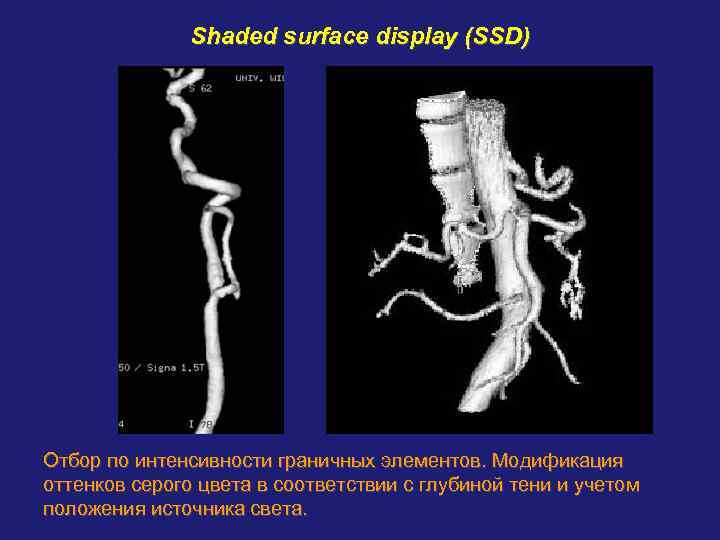    Shaded surface display (SSD) Отбор по интенсивности граничных элементов. Модификация оттенков