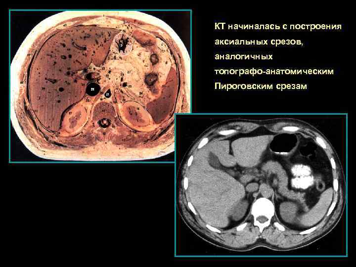 КТ начиналась с построения аксиальных срезов, аналогичных топографо-анатомическим Пироговским срезам 