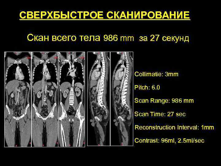 СВЕРХБЫСТРОЕ СКАНИРОВАНИЕ  Скан всего тела 986 mm за 27 секунд   