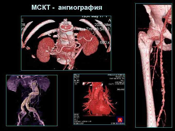 МСКТ - ангиография 