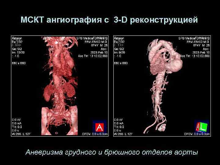 МСКТ ангиография с 3 -D реконструкцией Аневризма грудного и брюшного отделов аорты 