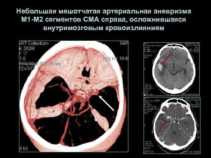 Небольшая мешотчатая артериальная аневризма М 1 -М 2 сегментов СМА справа, осложнившаяся  внутримозговым