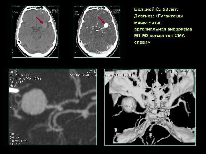Больной С. , 58 лет. Диагноз:  «Гигантская мешотчатая артериальная аневризма М 1 -М