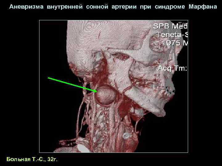  Аневризма внутренней сонной артерии при синдроме Марфана Больная Т. -С. , 32 г.