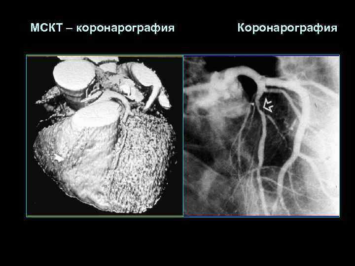 МСКТ – коронарография  Коронарография 