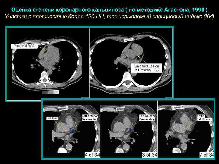  Оценка степени коронарного кальциноза ( по методике Агастона, 1990 ) Участки с плотностью
