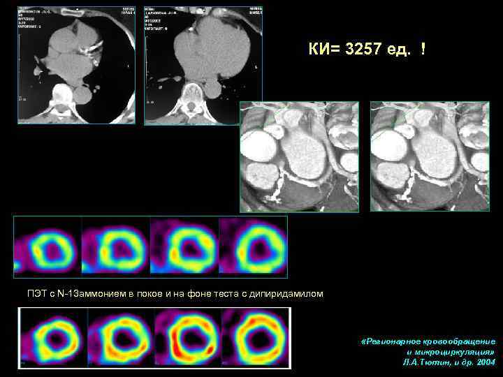      КИ= 3257 ед. ! ПЭТ с N-13 аммонием в