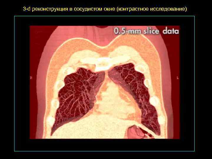 3 -d реконструкция в сосудистом окне (контрастное исследование) 