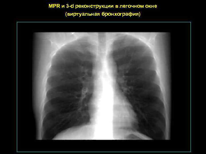 MPR и 3 -d реконструкции в легочном окне (виртуальная бронхография) 