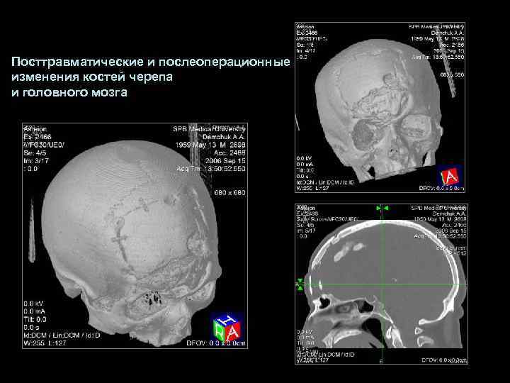 Посттравматические и послеоперационные изменения костей черепа и головного мозга 