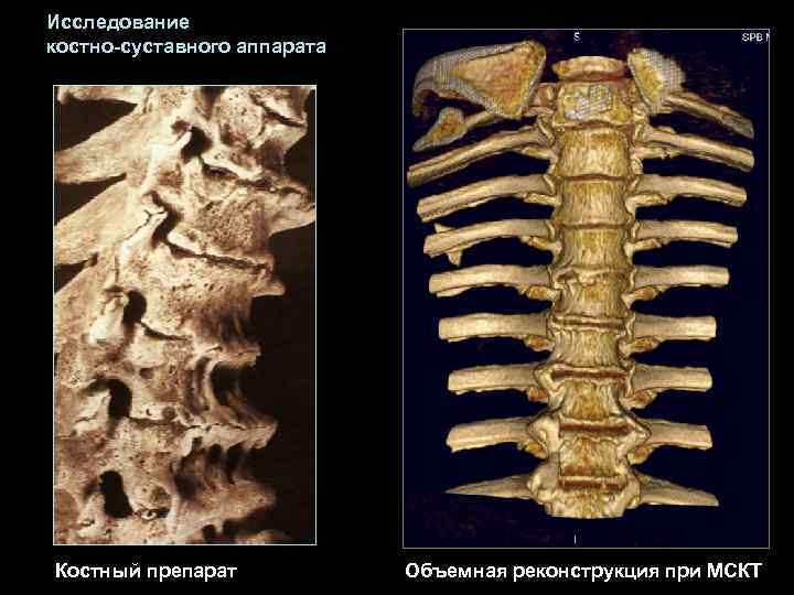 Исследование костно-суставного аппарата Костный препарат   Объемная реконструкция при МСКТ 