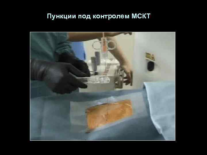 Пункции под контролем МСКТ 