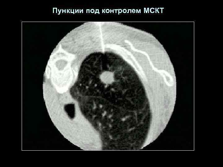 Пункции под контролем МСКТ 