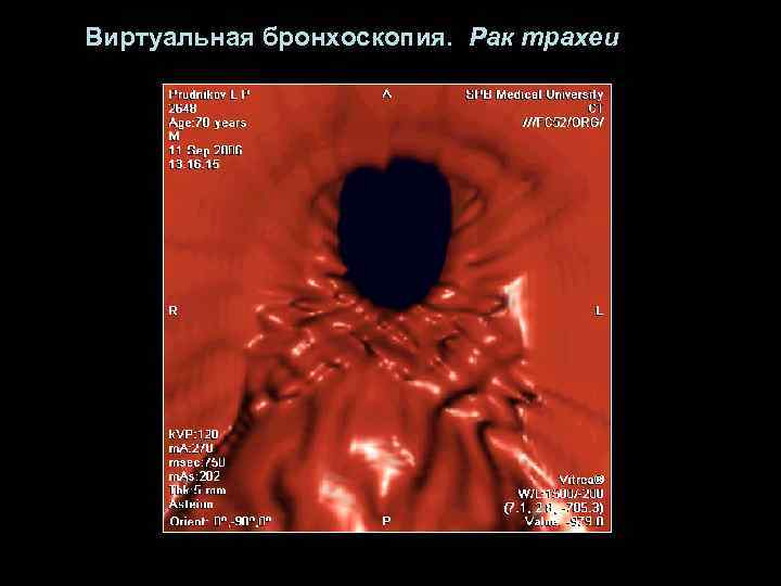 Виртуальная бронхоскопия. Рак трахеи 