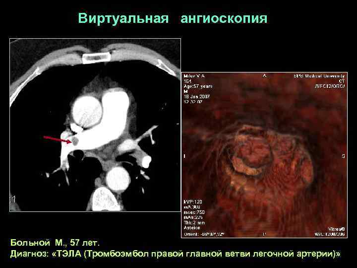    Виртуальная ангиоскопия Больной М. , 57 лет. Диагноз:  «ТЭЛА (Тромбоэмбол