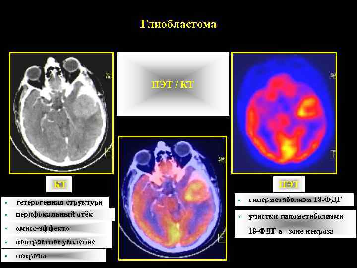      Глиобластома      ПЭТ / КТ