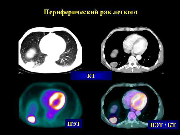 Периферический рак легкого   КТ  ПЭТ / КТ 