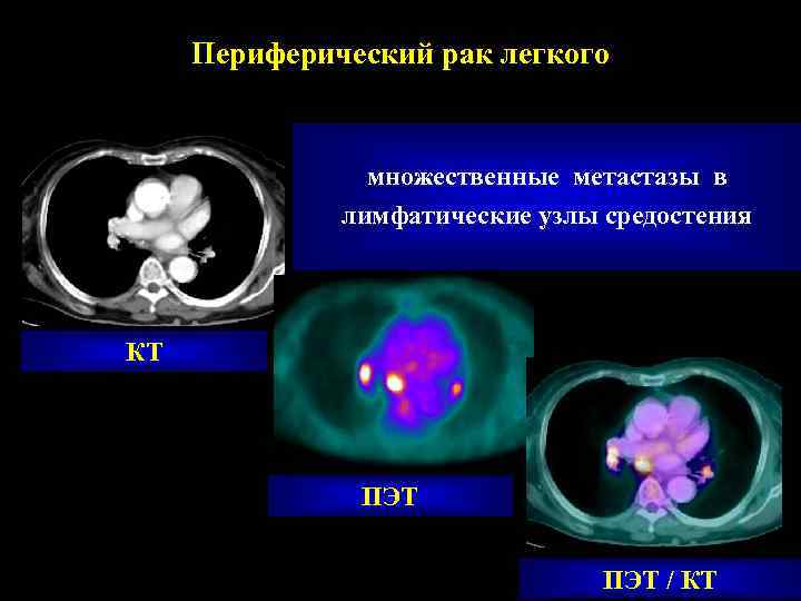  Периферический рак легкого    множественные метастазы в    лимфатические