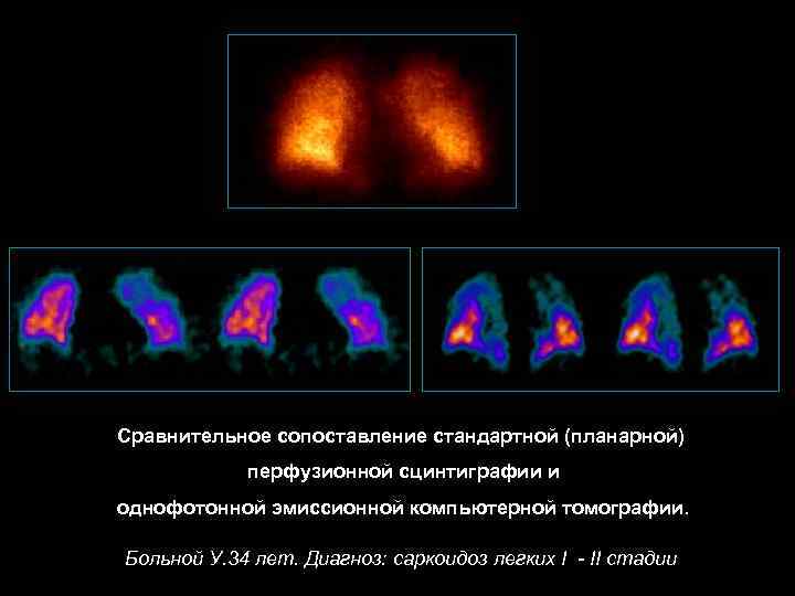Сравнительное сопоставление стандартной (планарной)   перфузионной сцинтиграфии и однофотонной эмиссионной компьютерной томографии. 