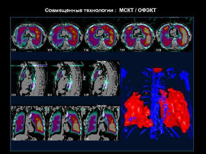 Совмещенные технологии : МСКТ / ОФЭКТ 