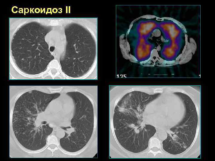 Саркоидоз II 