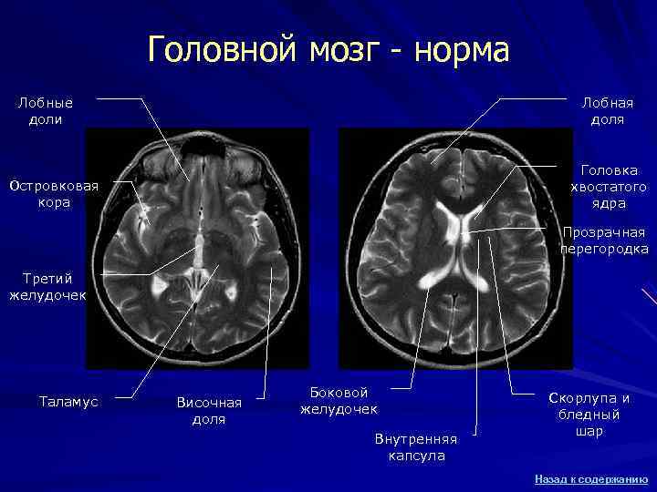 Головной мозг - норма Лобные Лобная доли Головной мозг - норма Лобные Лобная доли