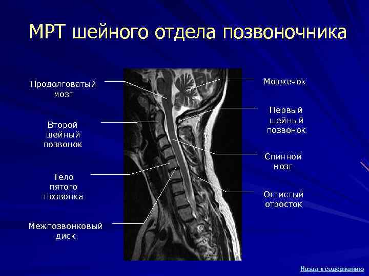 МРТ шейного отдела позвоночника Продолговатый Мозжечок мозг Первый МРТ шейного отдела позвоночника Продолговатый Мозжечок мозг Первый