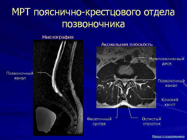 МРТ пояснично-крестцового отдела позвоночника Миелография МРТ пояснично-крестцового отдела позвоночника Миелография
