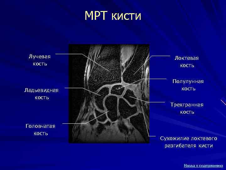 МРТ кисти Лучевая Локтевая кость МРТ кисти Лучевая Локтевая кость