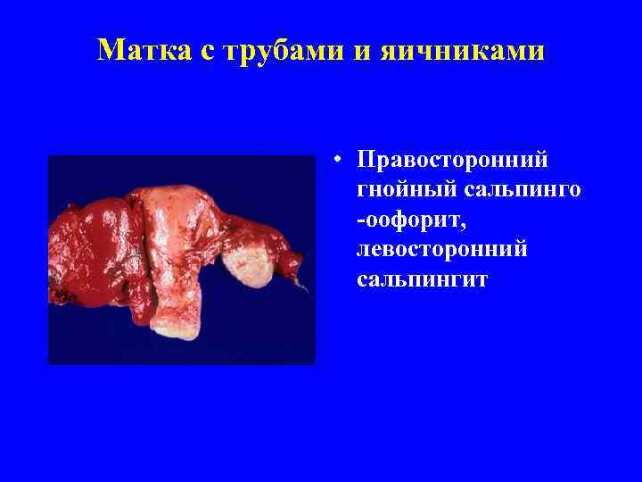 Матка с трубами и яичниками    • Правосторонний   гнойный сальпинго