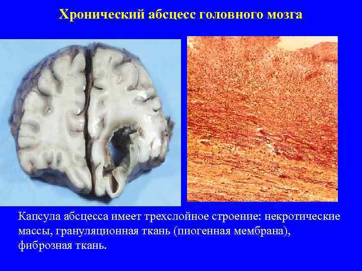   Хронический абсцесс головного мозга Капсула абсцесса имеет трехслойное строение: некротические массы, грануляционная