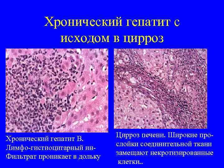   Хронический гепатит с    исходом в цирроз   