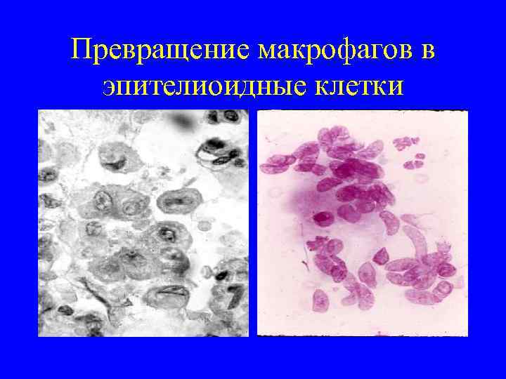 Превращение макрофагов в  эпителиоидные клетки 