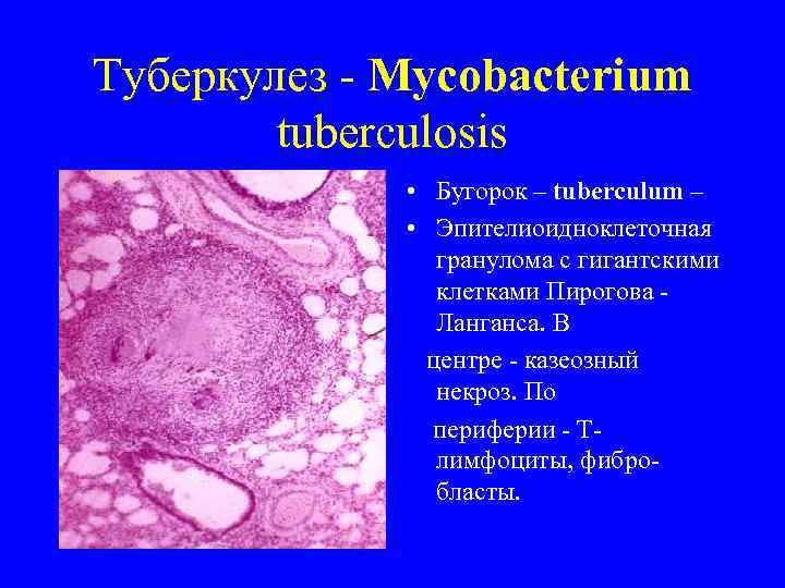 Туберкулез - Mycobacterium   tuberculosis    • Бугорок – tuberculum –