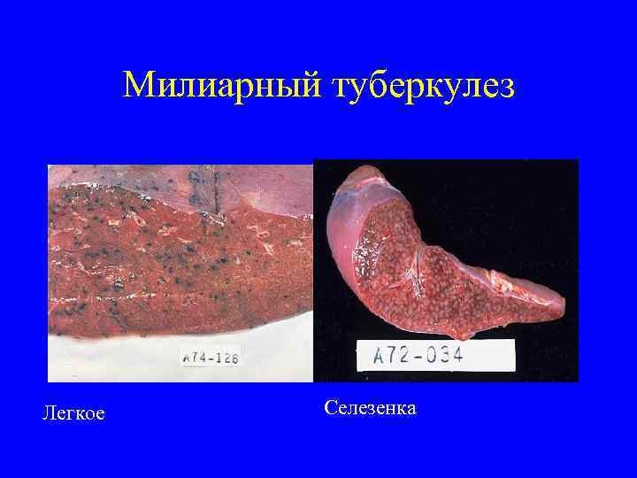    Милиарный туберкулез Легкое   Селезенка 