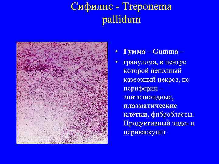Сифилис - Treponema  pallidum     • Гумма – Gumma –