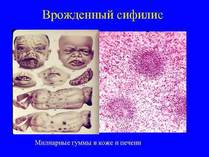 Врожденный сифилис Милиарные гуммы в коже и печени 