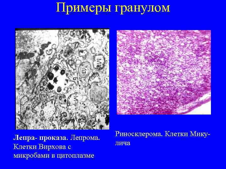   Примеры гранулом       Риносклерома. Клетки Мику- Лепра-