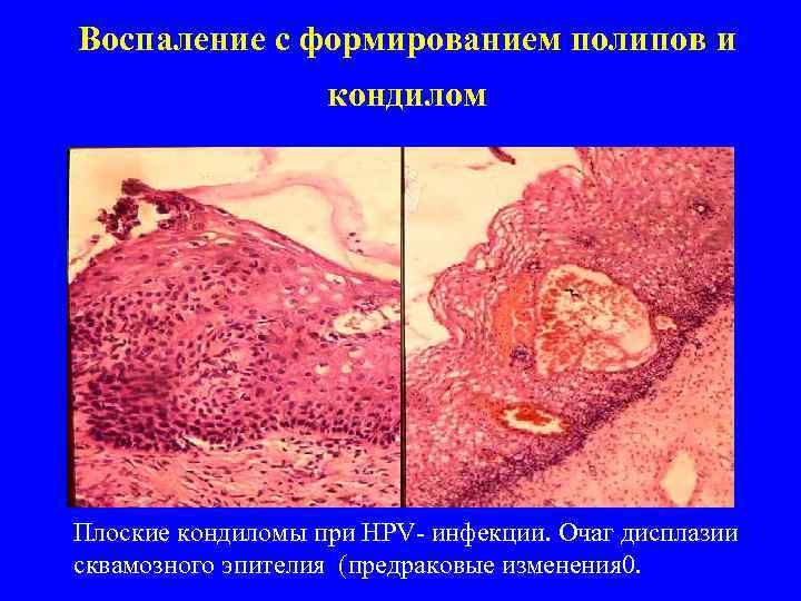 Воспаление с формированием полипов и     кондилом Плоские кондиломы при НРV-