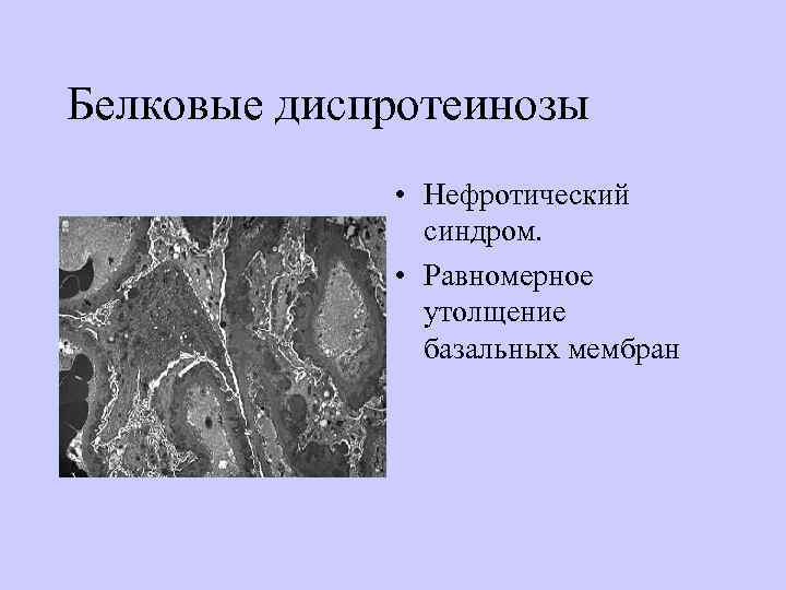 Белковые диспротеинозы    • Нефротический   синдром.   • Равномерное