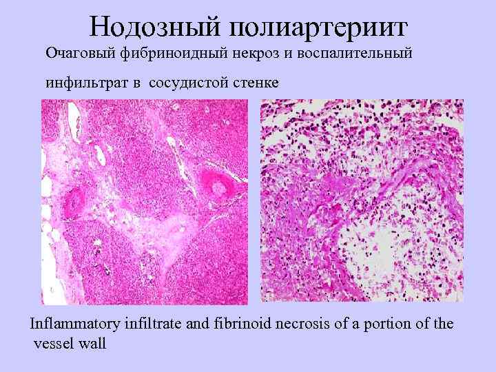    Нодозный полиартериит  Очаговый фибриноидный некроз и воспалительный  инфильтрат в