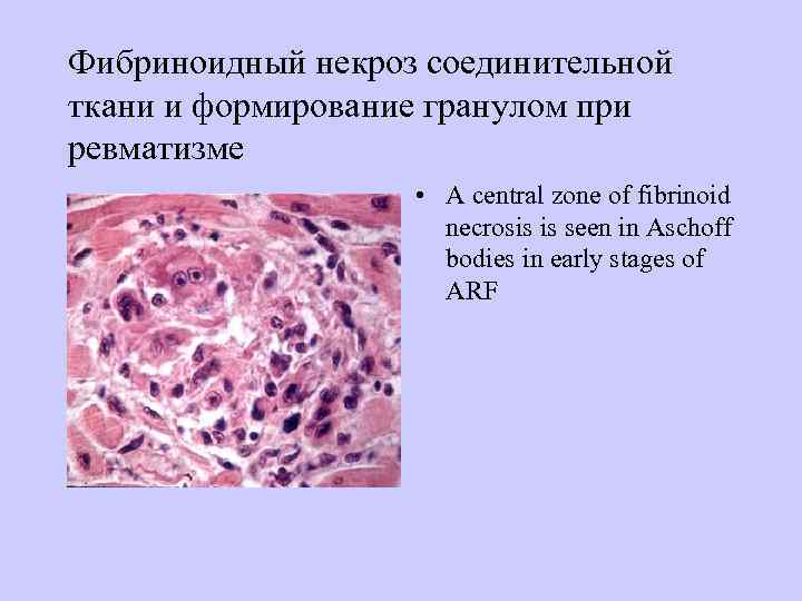 Фибриноидный некроз соединительной ткани и формирование гранулом при ревматизме     •