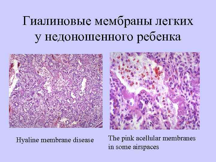  Гиалиновые мембраны легких у недоношенного ребенка Нyaline membrane disease  Тhe pink acellular