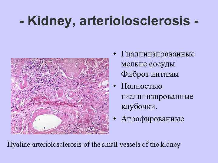   - Kidney, arteriolosclerosis -    • Гиалинизированные   