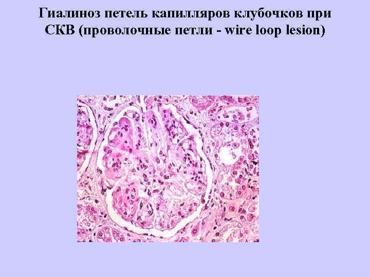Гиалиноз петель капилляров клубочков при  СКВ (проволочные петли - wire loop lesion) 