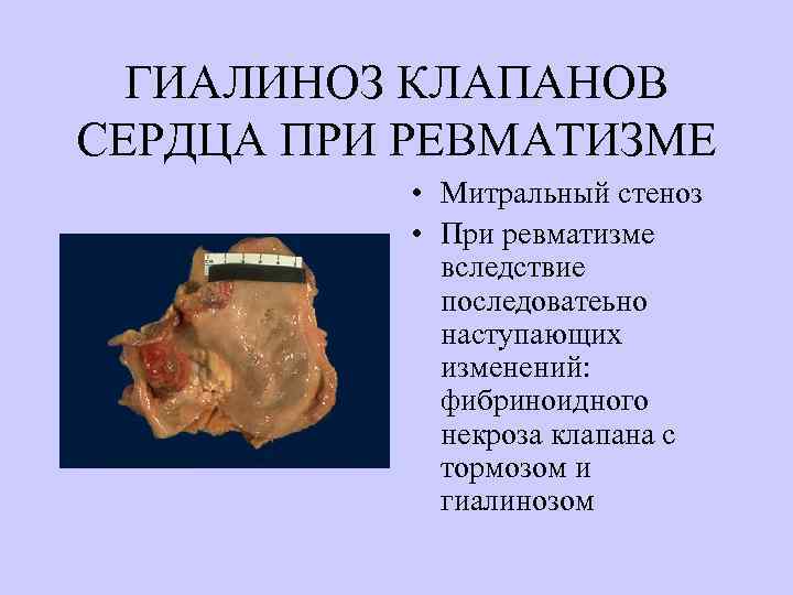  ГИАЛИНОЗ КЛАПАНОВ СЕРДЦА ПРИ РЕВМАТИЗМЕ  • Митральный стеноз   • При