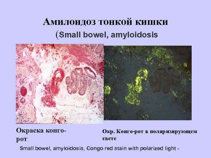    Амилоидоз тонкой кишки  (Small bowel, amyloidosis Окраска конго-  