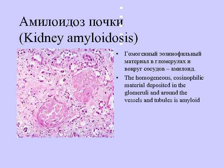Амилоидоз почки (Kidney amyloidosis)    • Гомогенный эозинофильный    материал