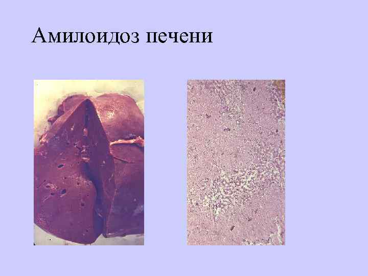 Амилоидоз печени 