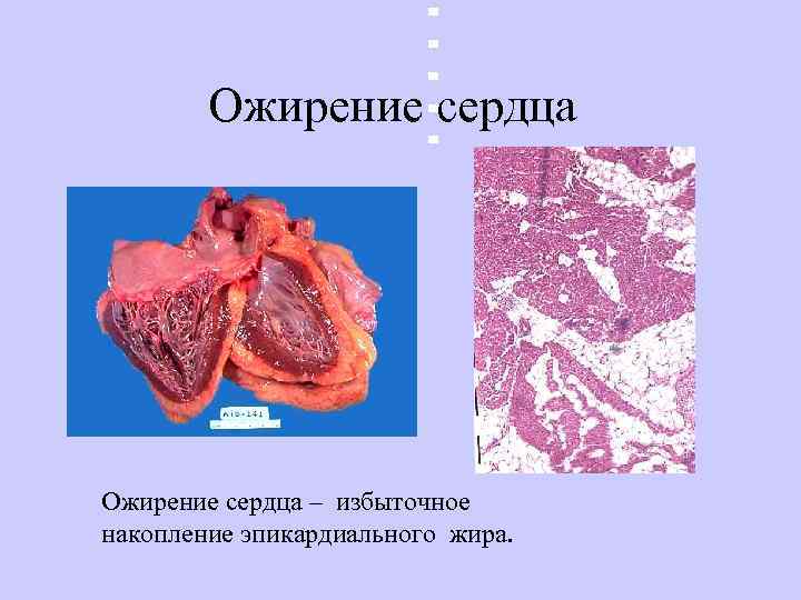   Ожирение сердца – избыточное накопление эпикардиального жира.  